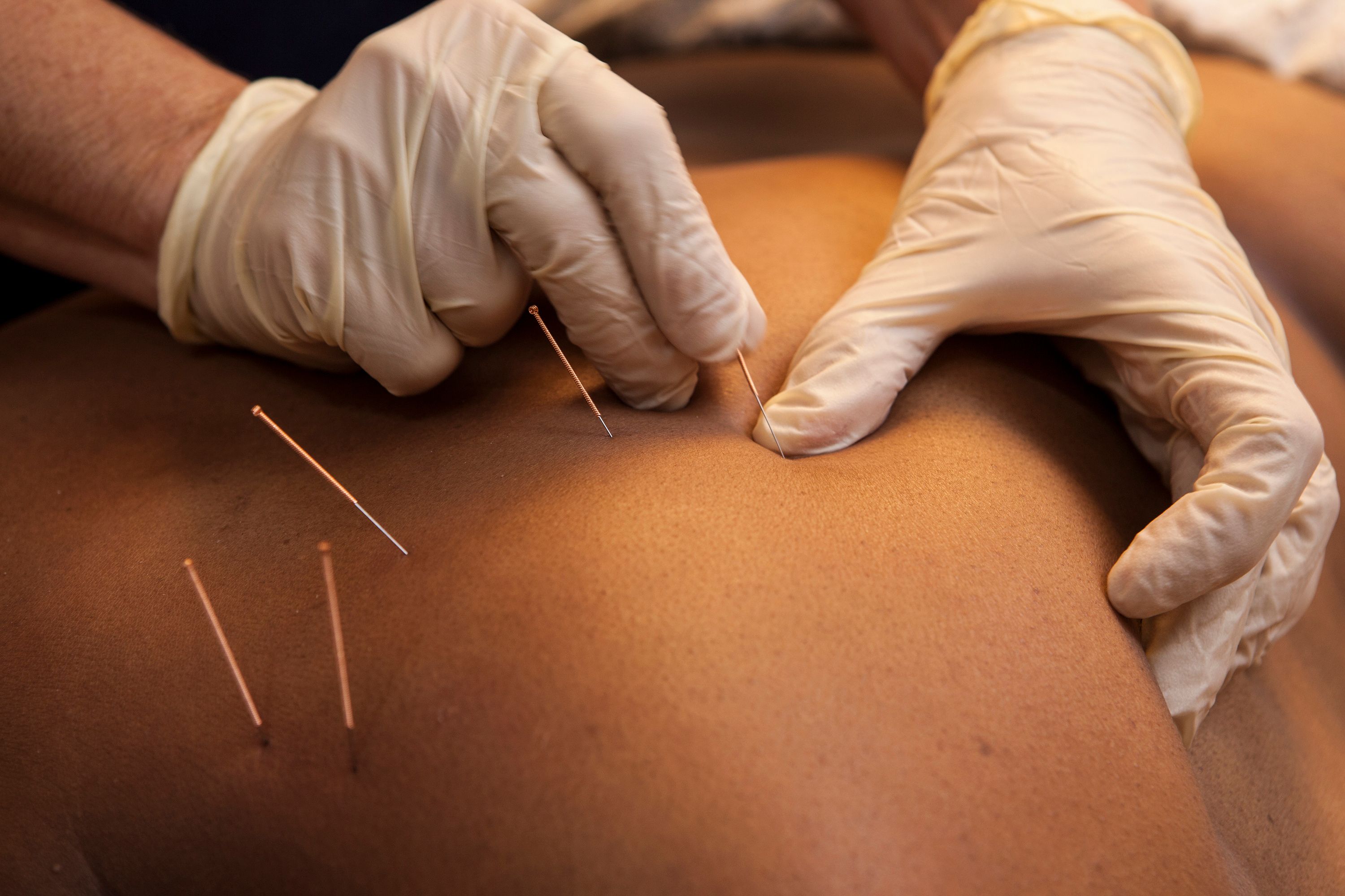 Dry Needling